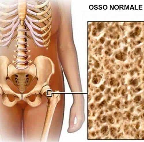 Osteoporosi non solo vecchi. Concorso Claudia Matta per le scuole